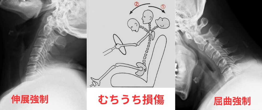 むちうちの原理