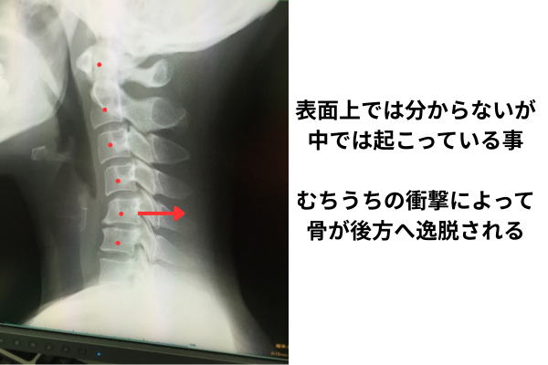 むちうちの損傷